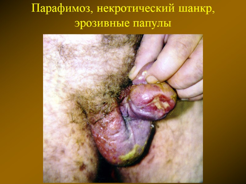 Парафимоз, некротический шанкр, эрозивные папулы